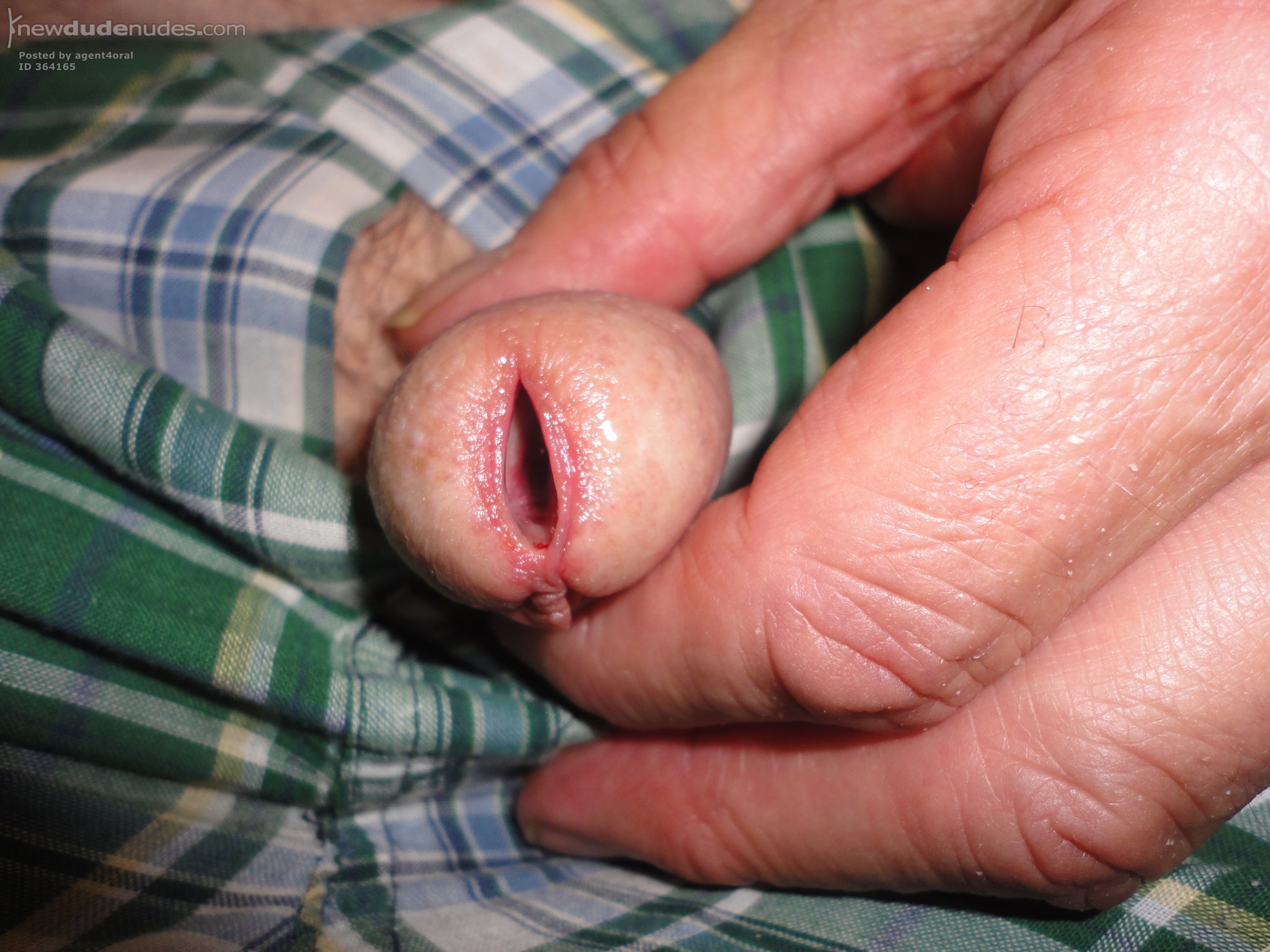 My gaping meatus