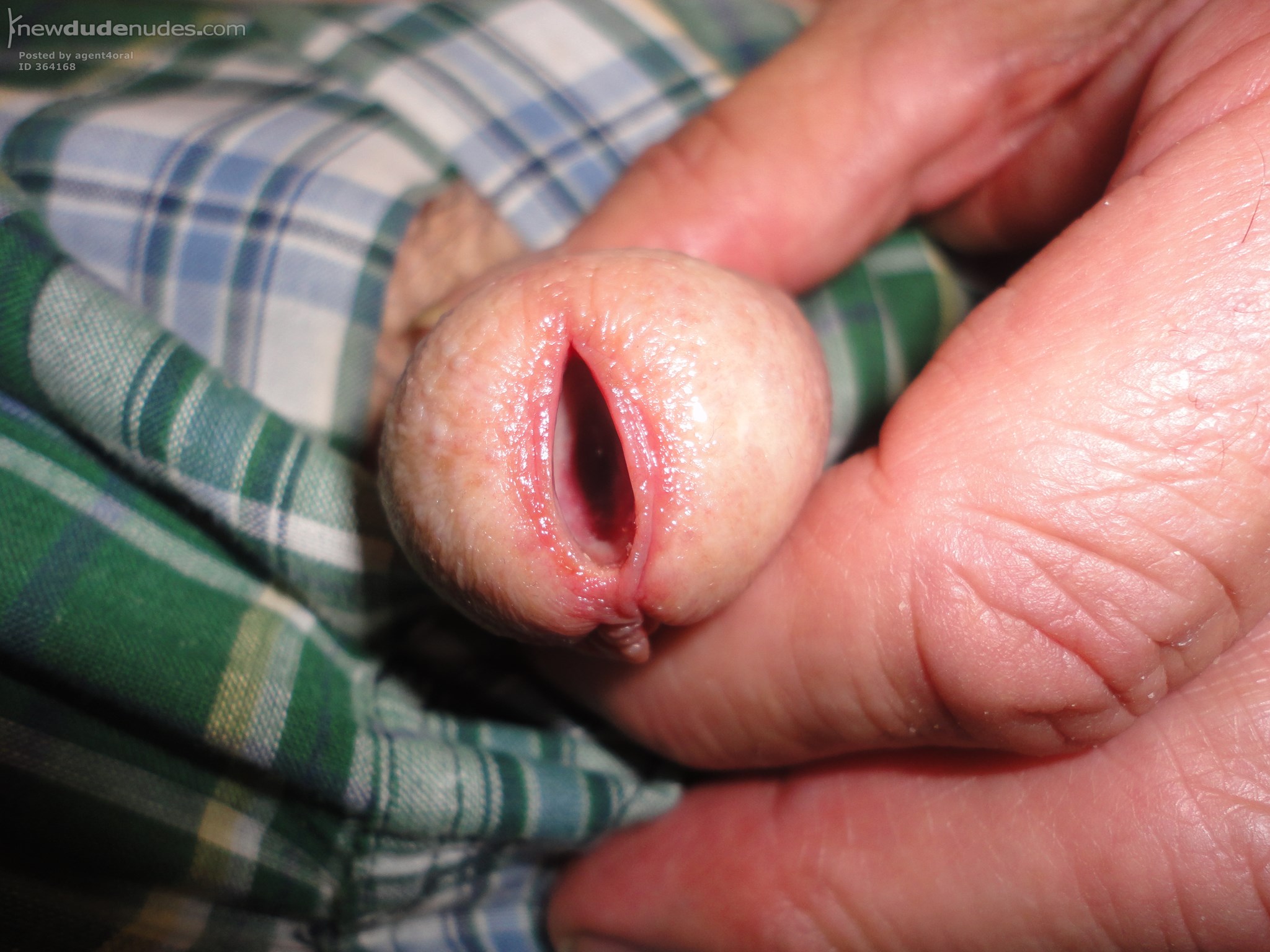 My gaping meatus